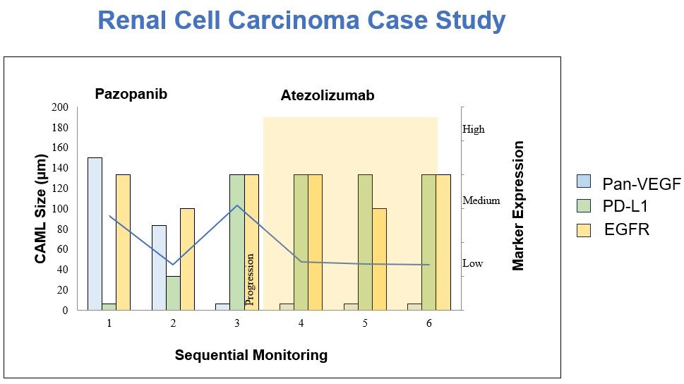 Bar chart tracking CAML size and marker expression (Pan-VEGF, PD-L1, EGFR) across 6 blood draws in a renal cell carcinoma patient, showing disease progression at draw 3 before switching from Pazopanib to Atezolizumab.